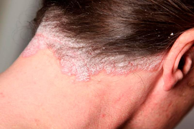 Причины дерматита на голове